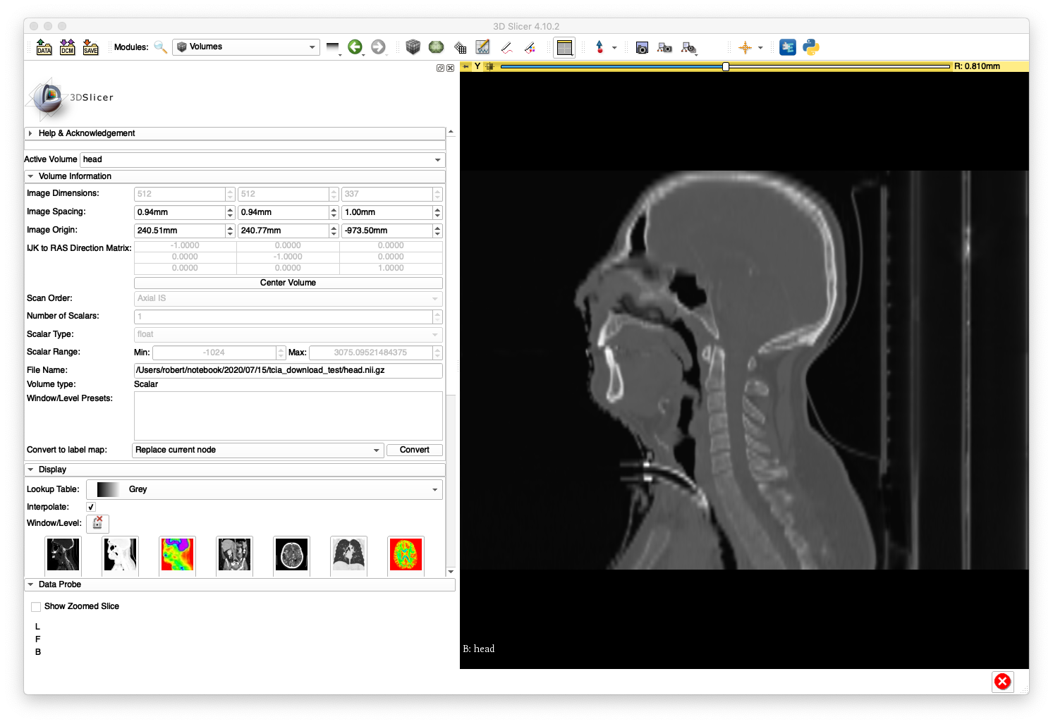 Example 2 Good Sagittal Slice